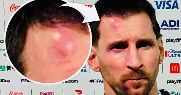 Messi sưng vêu trán sau trận thắng Cabo Verde: Vì sao nên nỗi? - hình ảnh - shbetv.vip Messi sưng vêu trán sau trận thắng Cabo Verde: Vì sao nên nỗi? - hình ảnh - shbetv.vip